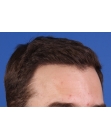 After Hair Transplant&nbsp;Hairlines